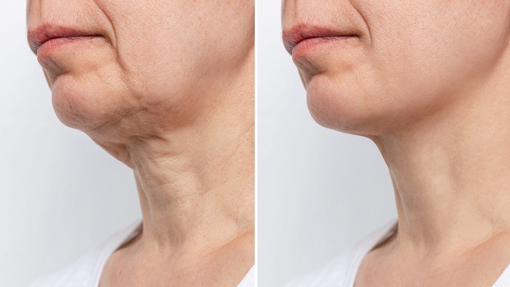 Lavi Age Peeling Medium